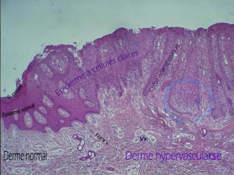 acanthome  cellules claires vu au microscope en faible grossissement. Cliquer sur l'image pour agrandir le cercle bleu