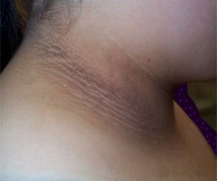 acanthosis nigricans du cou