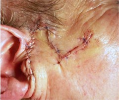 Joue preauriculaire après suture