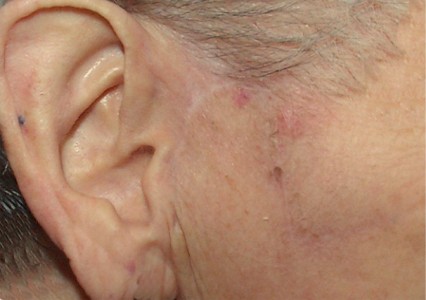 Joue preauriculaire après suture