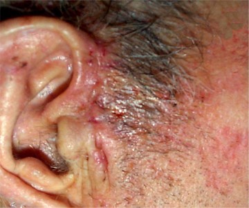 Carcinome basocellulaire de la joue cicatrice inflammatoire 2