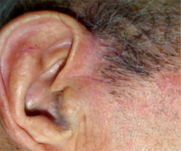 Carcinome basocellulaire de la joue cicatrice inflammatoire 3