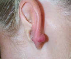 chéloïde de l'oreille après perçage du lobule