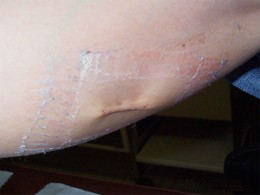 suture éversante sur le mollet au début