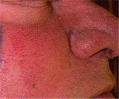Erythro-couperose du visage