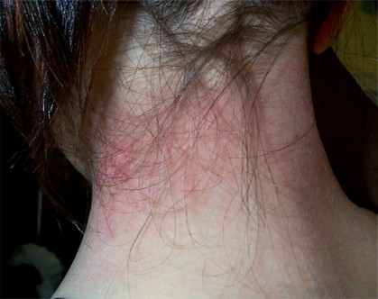 Ecéma lichénifié de la nuque chez une adolescente