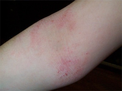 Eczéma lichénifié du pli du coude