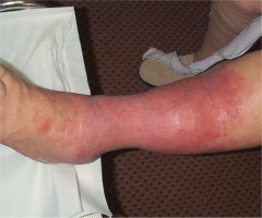 erysipèle de la jambe sur terrrain variqueux