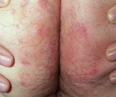 intertrigo des fesses à T rubrum