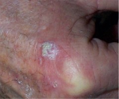 papilloma virus naso