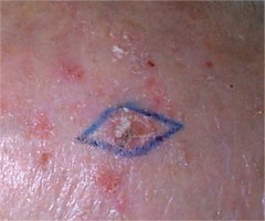 keratoses actiniques du crne