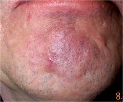 kyste du menton : cicatrice 1 mois après intervention