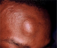 Lipome frontal