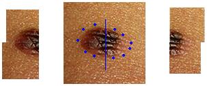 melanome multicolore de la cuisse