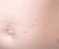 molluscum contagiosum de l'abdomen chez un enfant