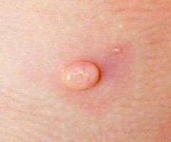 molluscum contagiosum