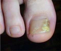 Mycose unguéale (onyxis) du gros orteil