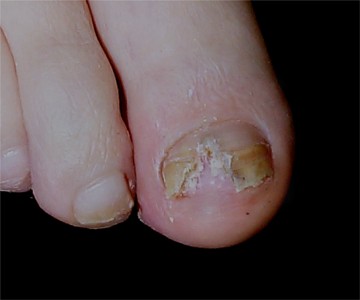 Aspect de l'ongle après prélèvement
