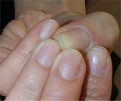Criblures horizontales des ongles peladiques