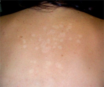 Pityriasis versicolor achromique