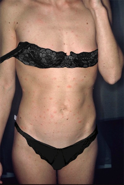 Pityriasis rose de Gibert: répartition des lésions