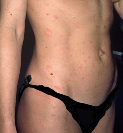 Pityriasis ros de Gibert : distinguer le mdaillon initial et les lsions secondaires