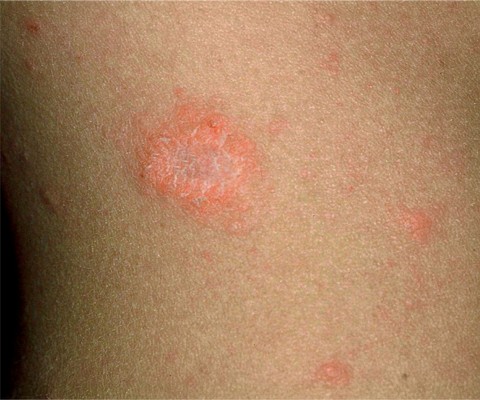 Pityriasis rosea | DermNet New Zealand