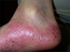 Psoriasis pustuleux : Pustules rcentes jauntres et pustules anciennes marron