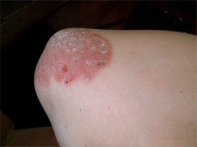 psoriasis du coude