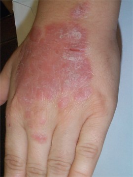 Psoriasis rythmateux du dos de la main