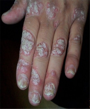 Psoriasis kratosique de la main