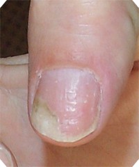 Psoriasis de l'ongle debutant