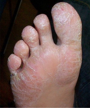 Psoriasis plantaire kratosique chez un enfant