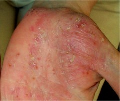 Psoriasis pustuleux de la paume de la main