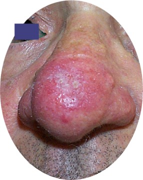 Rosace rhinophyma du nez