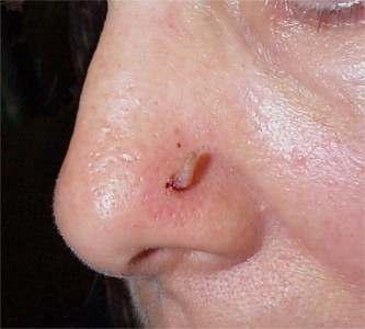 Papillome corné du nez (HPV 2)