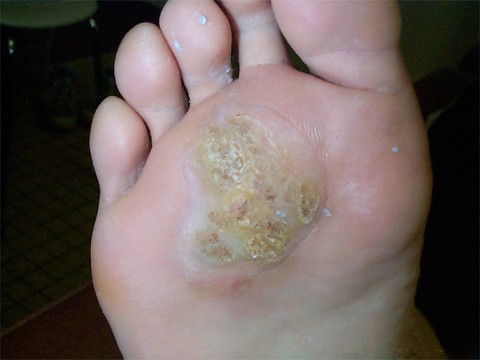Verrues plantaires en mosaïque (HPV 2)