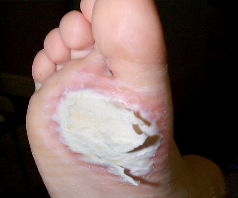 Verrues après 3 semaines de traitement par vaseline salicylée