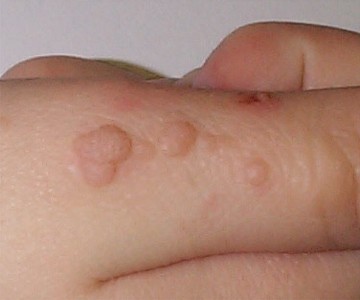 Verrues vulgaires des mains (HPV 2 ou 4)