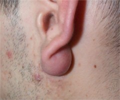 Inflammation d'un kyste sbac du lobule de l'oreille